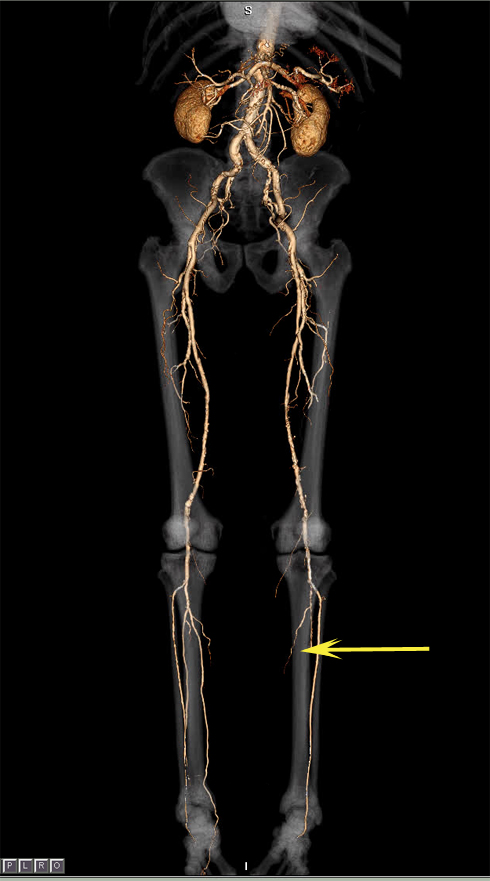 CT ANGIOGRAPHY LOWER LIMBS