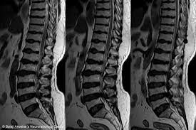 CT SCAN DORSAL SPINE (CONTRAST)