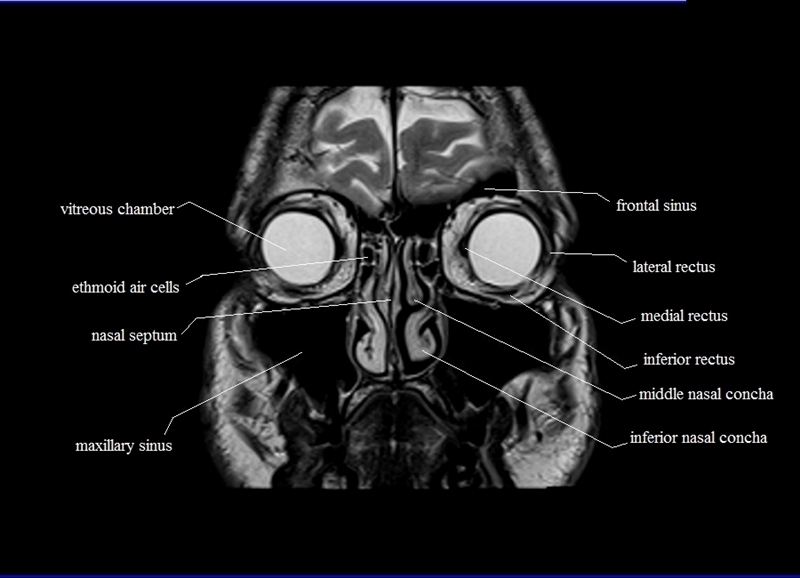 CECT SCAN PNS  AXIAL (CONTRAST)