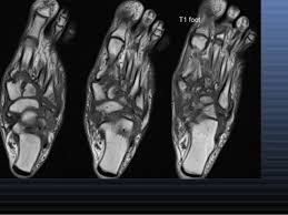 MRI LT FOOT (PLAIN)