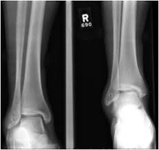 MRI LT LEG (PLAIN)