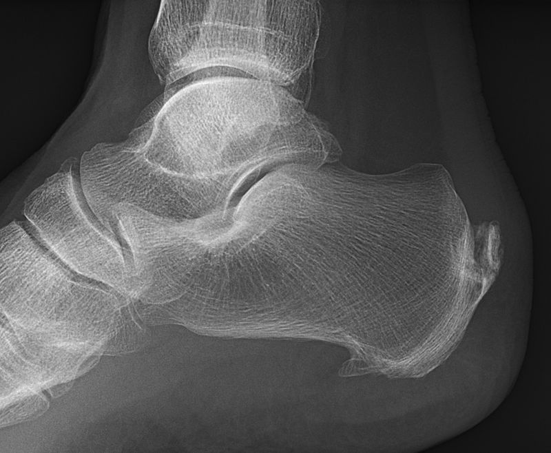 X-RAY AXIAL/LATERAL VIEW RT CALCANEAM 