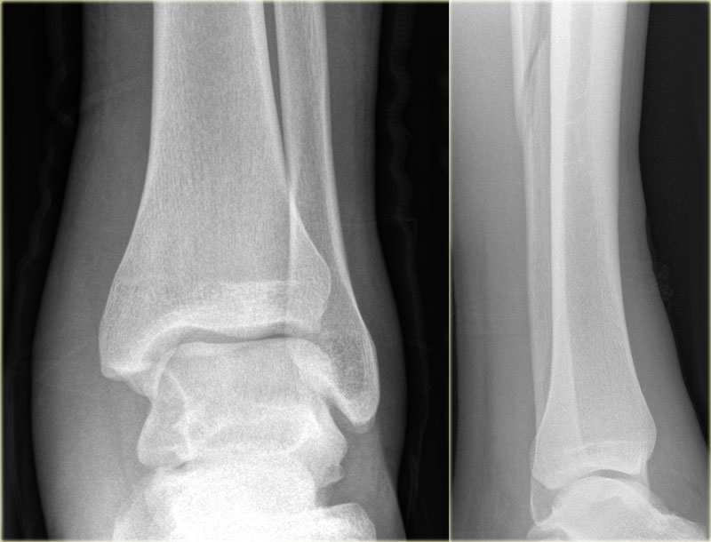 X-RAY AP/LATERAL VIEW RT ANKLE