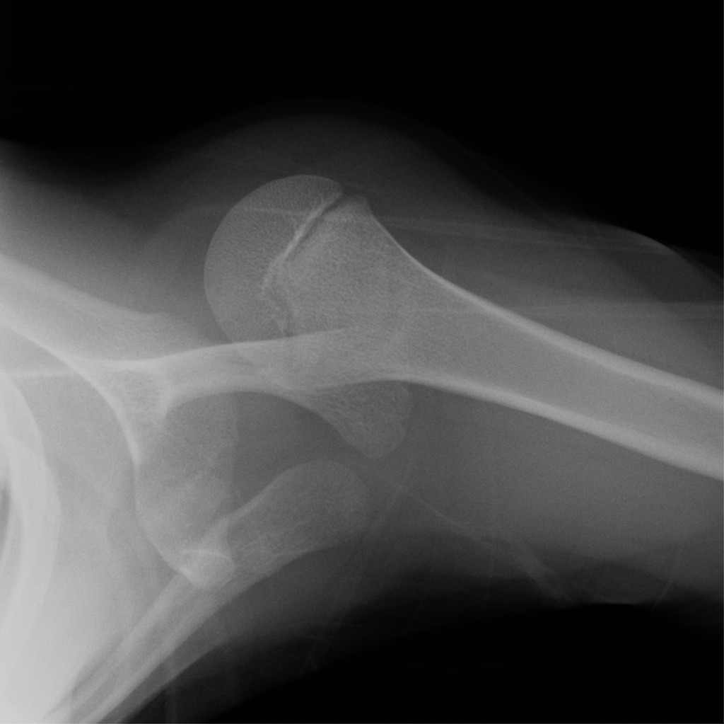 X-RAY OBLIQUE VIEW BOTH SHOULDER