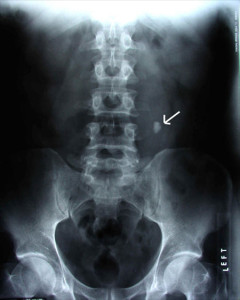 X-RAY AP/ATERAL VIEW COXXY