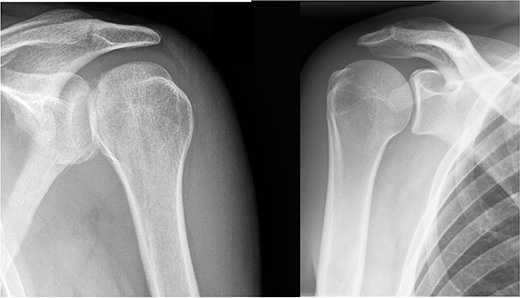 X-RAY AP/LATERAL VIEW LT SHOULDER