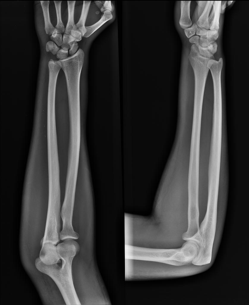 X-RAY LATERAL VIEW LT FOREARM