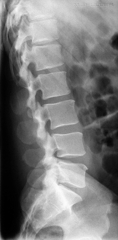X-RAY LATERAL VIEW LUMBAR SPINE