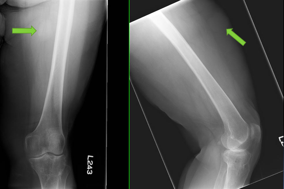 X-RAY AP/LATERAL VIEW LT THIGH