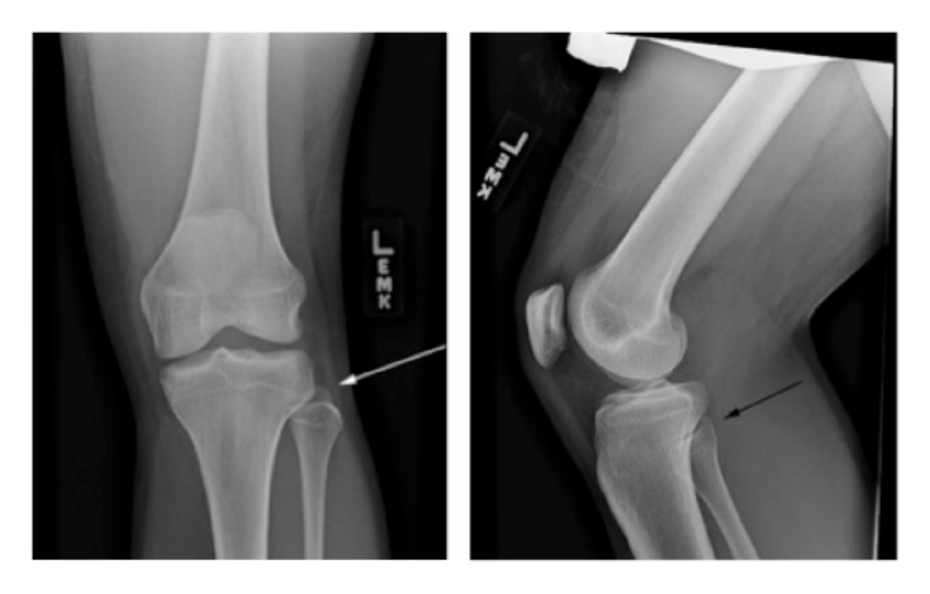 X-RAY AP/LATERAL VIEW LT KNEE (STN)