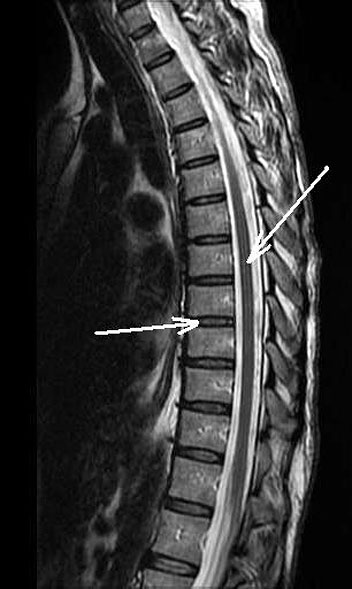 X-RAY LATERAL VIEW DORSAL SPINE