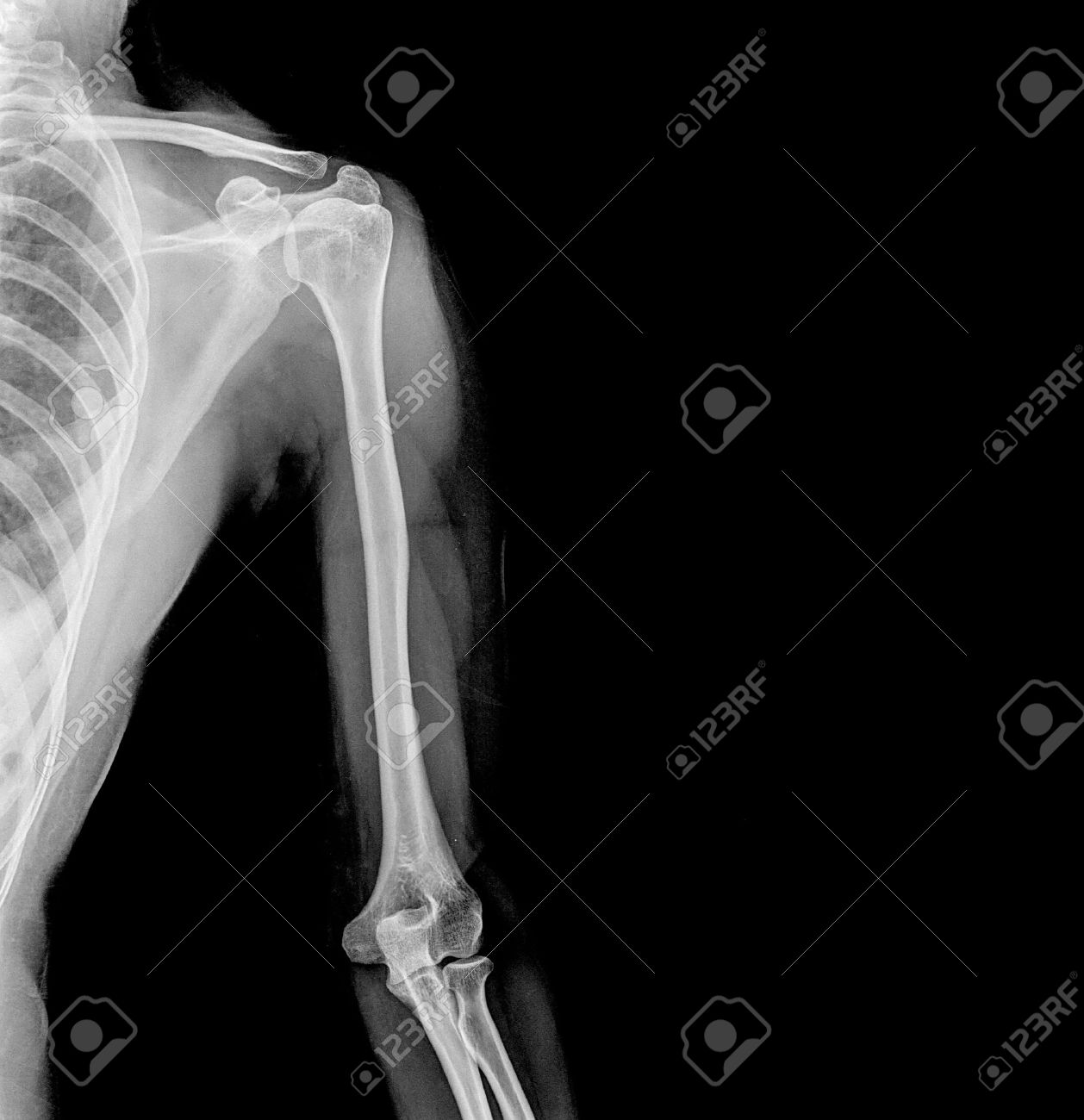 X-RAY AP/LATERAL VIEW RT ARM