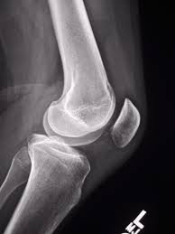 X-RAY LATERAL VIEW RT KNEE (STN)