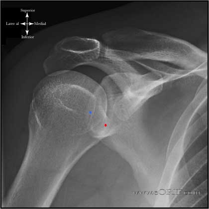 X-RAY OBLIQUE VIEW RT SHOULDER