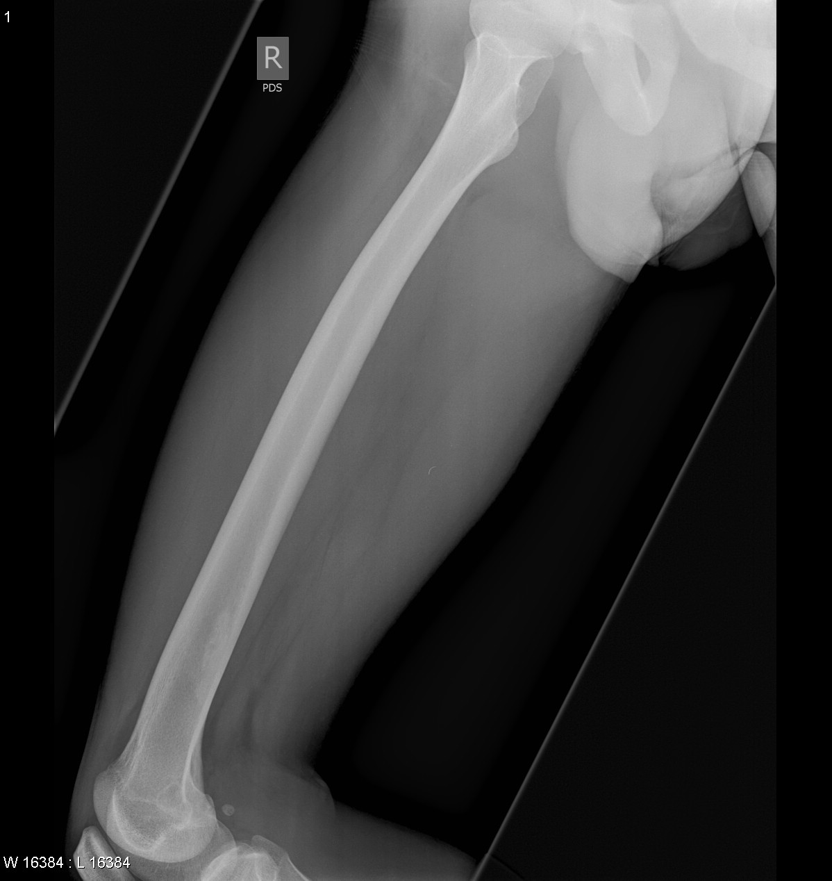X-RAY LATERAL VIEW BOTH THIGH