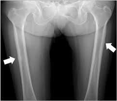 X-RAY LATERAL VIEW BOTH FEMUR